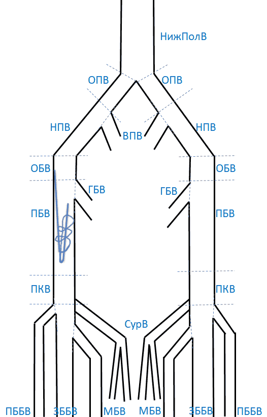 Инородное тело ОБВ и ПБВ (по типу перекрученной проволоки, струны или катетера)