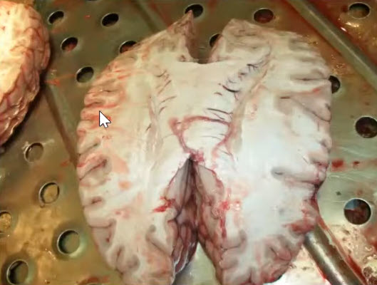 Отек мозга и множественные отсевы и кровоизлияния в кору и подкорковый слой