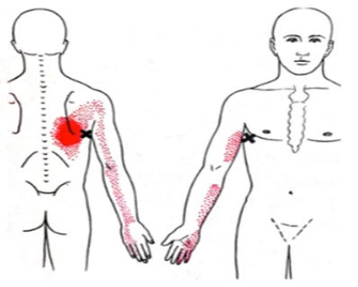 Широчайшая мышца спины "злокачественная боль спины"