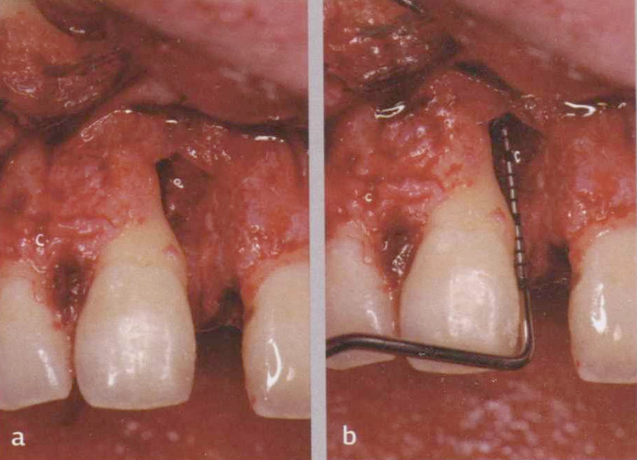 Фото 1.3 Хирургический вид внутрикостного дефекта, связанного с диастемой