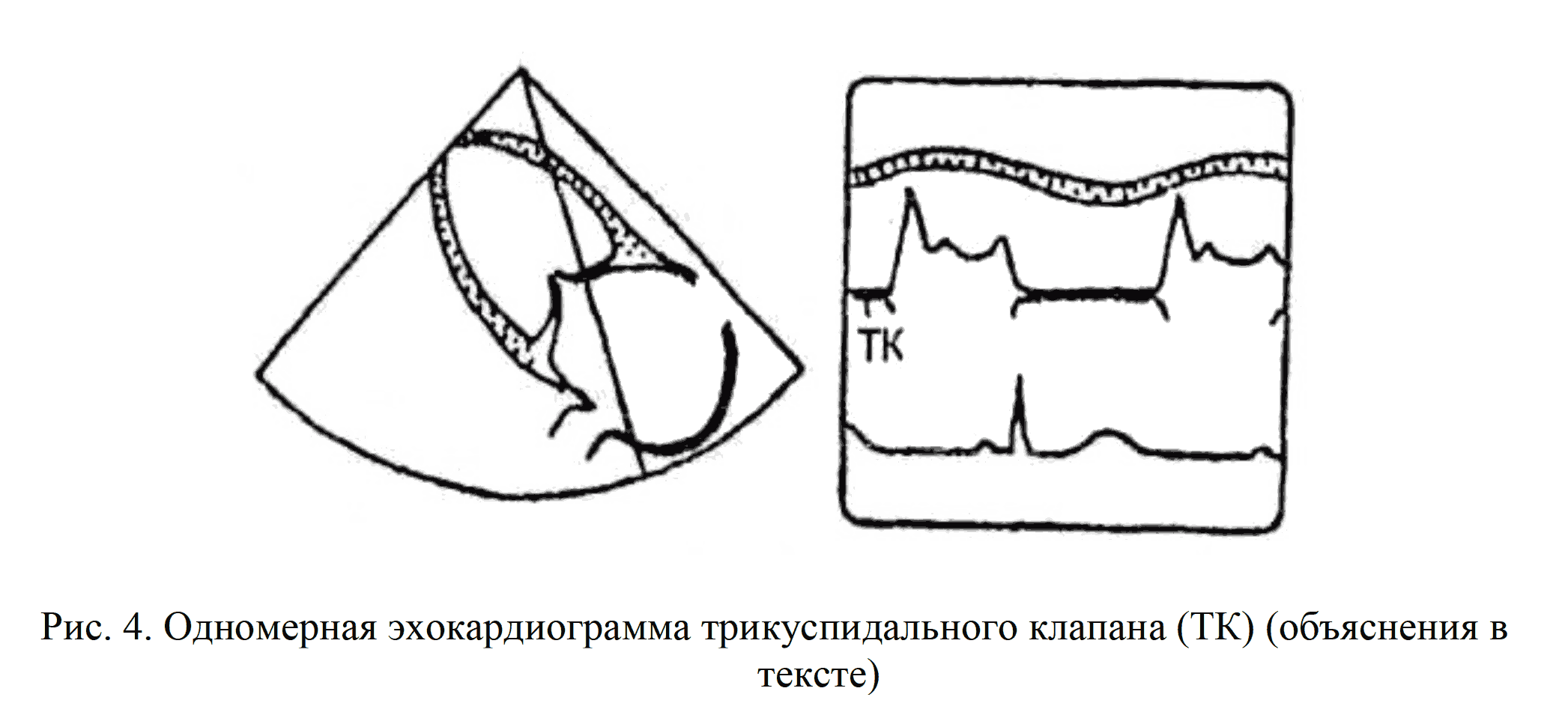 Рис. 4. Одномерная эхокардиограмма трикуспидального клапана (ТК)