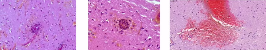 Инфекция вызывает васкулит с развитием тромбозов тромбоваскулит головного мозга
