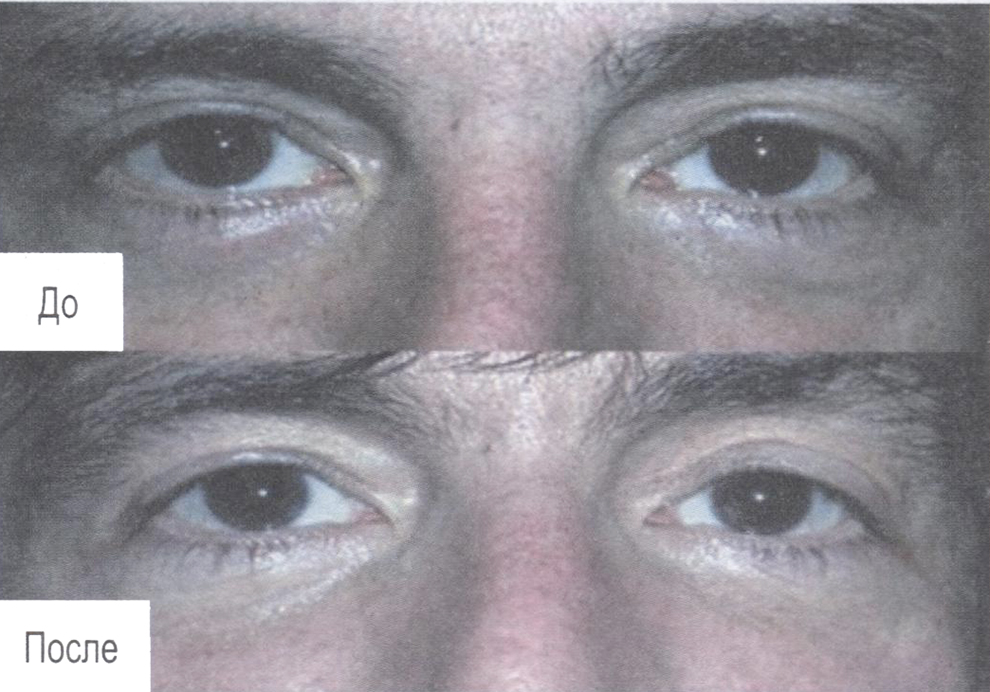 Уменьшение темных кругов под глазами, повышение эластичности кожи и уменьшение гиперпигментации под действием СО