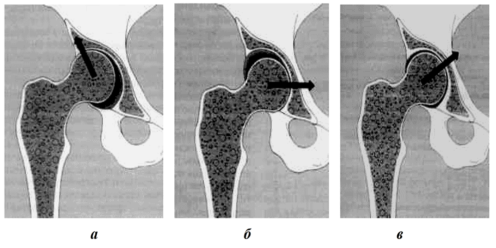 Рис. 4. Локализация (типы) остеоартроза тазобедренного сустава: а — верхнебоковая (~ 60 %; М>Ж); б — медиальная (~ 25 %; Ж>М); в — концентрическая (~ 15 %; Ж>М)