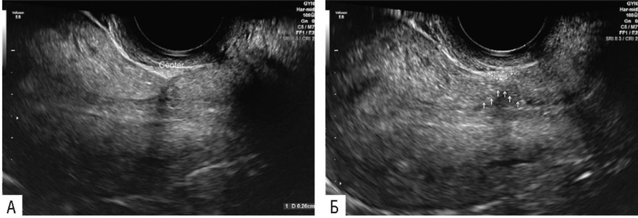 Ультразвуковое сканирование. Частичная несостоятельность рубца. Истончение миометрия