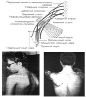 Невралгическая амиотрофия плечевого пояса