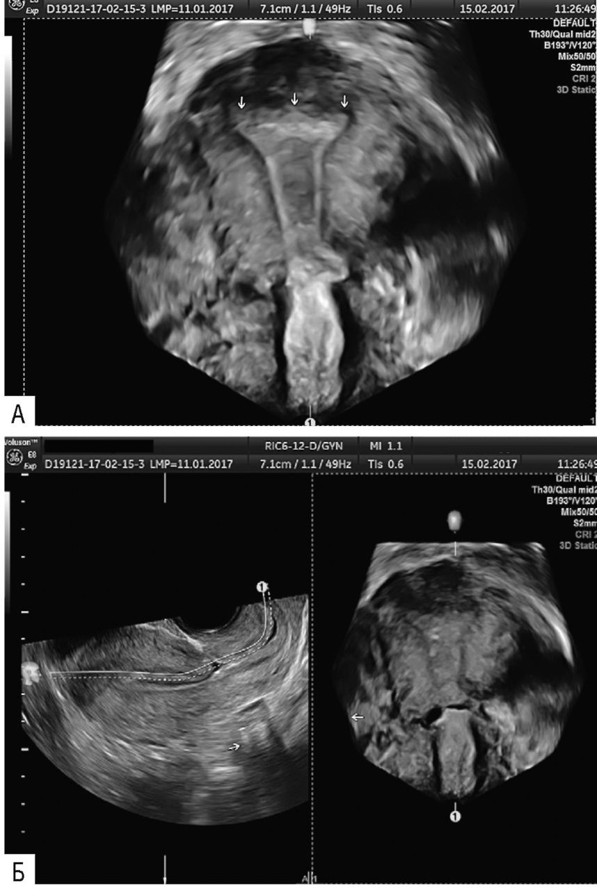 Рис. 4.8. А, Б. Ультразвуковое сканирование (Волюсон 8. 3D statica). Крупная «ниша», несостоятельный рубец.