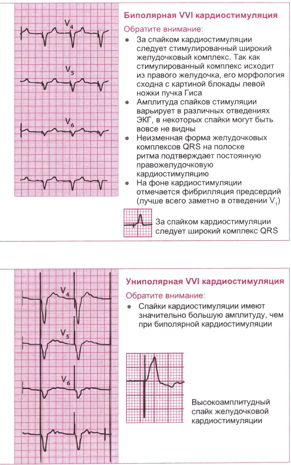 Униполярная VVI кардиостимуляция