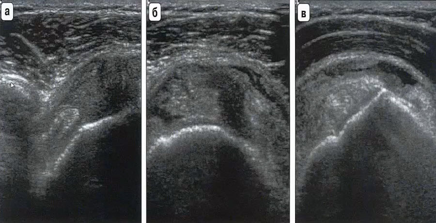 Аксиальный (а,б) и коронарный (в) срезы полного разрыва сухожилия надостной мышцы