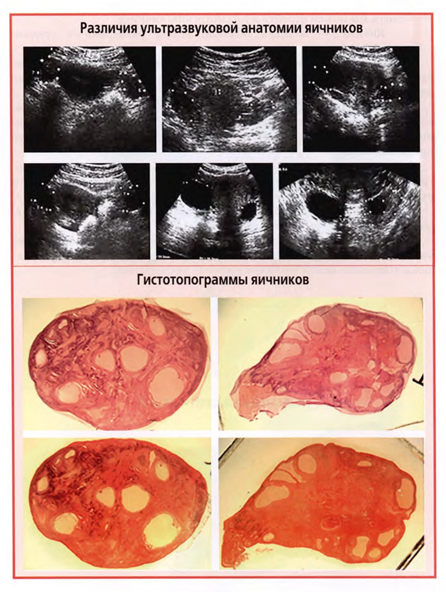Различия ультразвуковой анатомии яичников