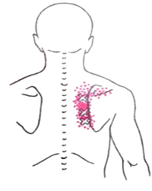 Большая и малая ромбовидные мышцы «поверхностная боль в спине и сутулость»