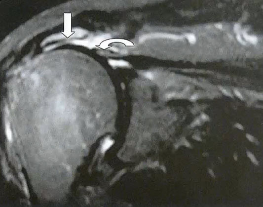 Коронарный срез в STIR-режиме, представляющий крупный разрыв надостной мышцы с ретракцией