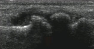 Хроническое воспаление оболочки сустава (синовит) приводит к развитию деформирующего артроза