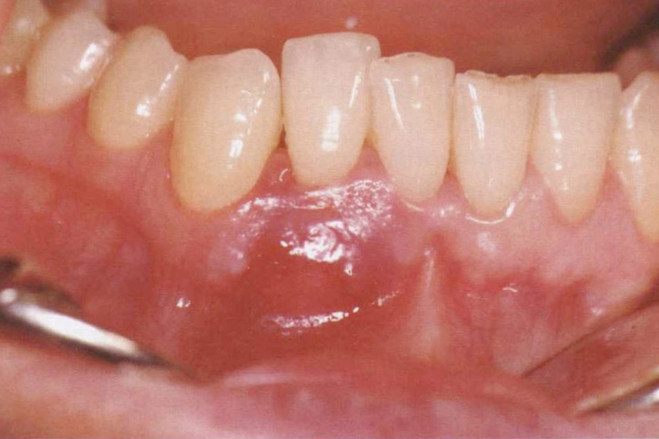 Фото 1.4. Скученность нижних резцов. Запрос пациента: ортодонтическая коррекция экструзии и скученности зубов
