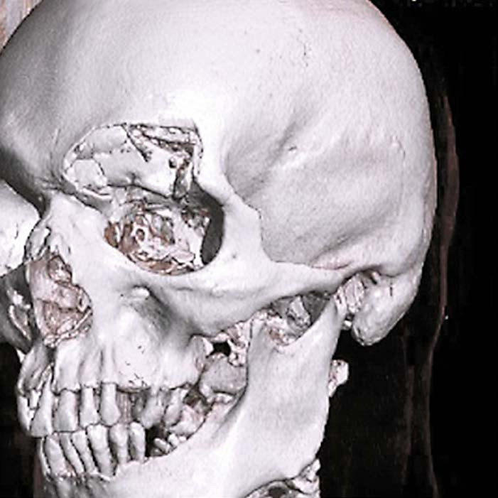 На снимке по МСКТ костей черепа в 3D-реконструкции определяется депрессионный вдавленный многооскольчатый перелом лобной пазухи
