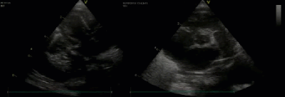 Спектр врожденных пороков сердца у новорожденных с ВДГ. Дефект межжелудочковой перегородки