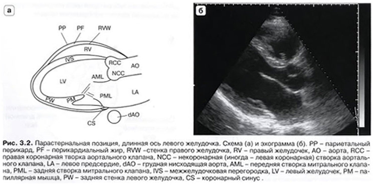 PLAX (Parasternal long axis view - парастернальная позиция, длинная ось левого желудочка)