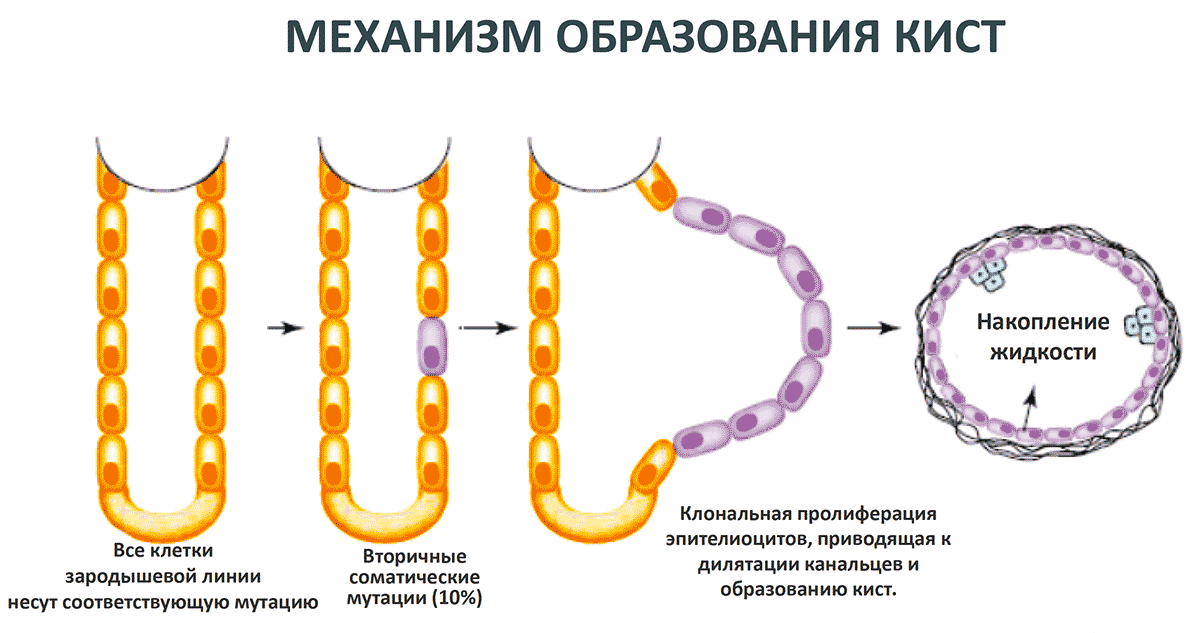 Механизм образования кист