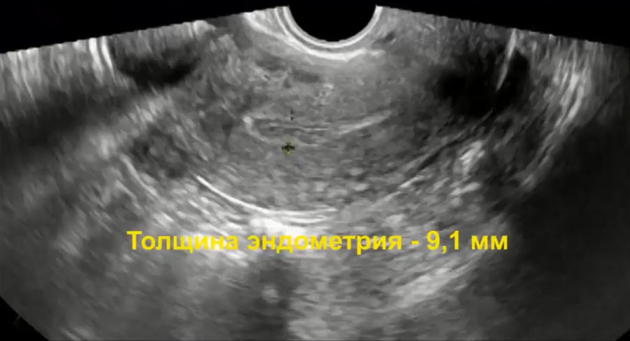 Толщина эндометрия - 9,1 мм