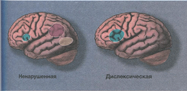 Мозговые механизмы дислексии Мозговые механизмы дислексии