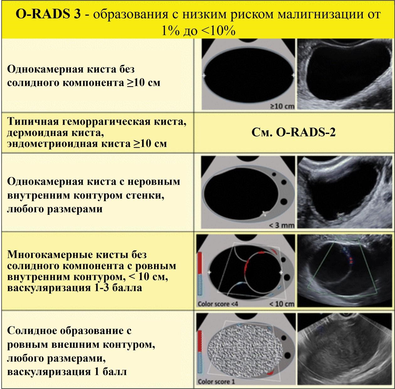 Рис. 6. Изображения, классифицируемые как O-RADS 3, патологические образования с низким риском малигнизации.