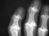 Рис. 9. Рентгенограмма суставов кисти при выраженном остеоартрозе