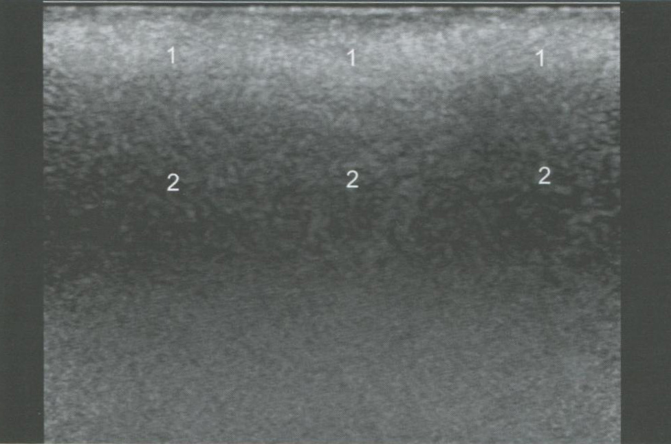 Рис. 6.1. УЗ-признаки фиброзных изменений мягких тканей верхней губы после КИП филлером на основе силикона