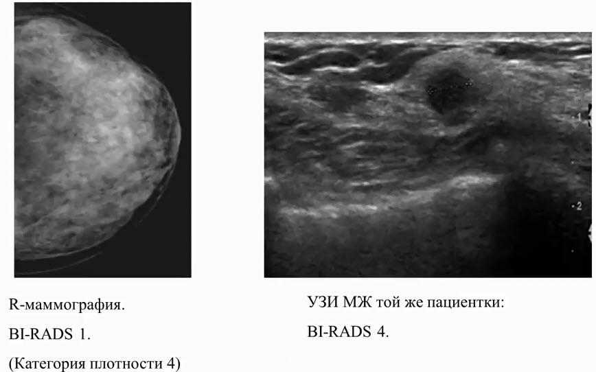 Пример не соответствия категорий BI-RADS при использовании различных методов клинической визуализации