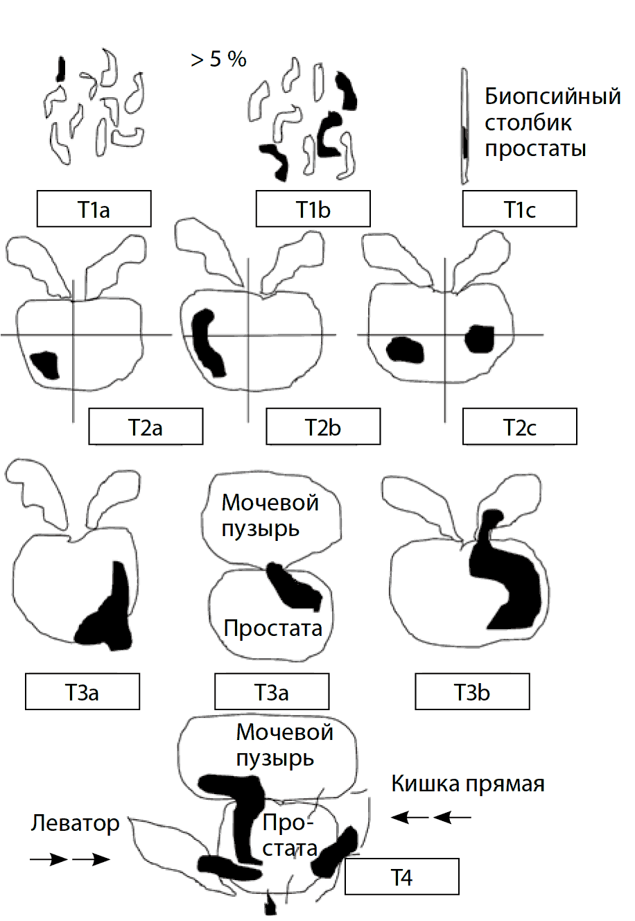   Рис. 8. Схематическая классификация рака предстательной железы по системе TNM (2010 г.)