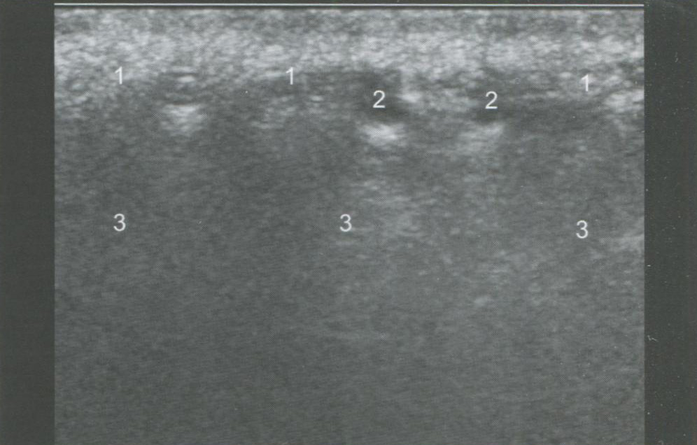 УЗ-признаки фиброзных изменений мягких тканей правой щечной области после КИП