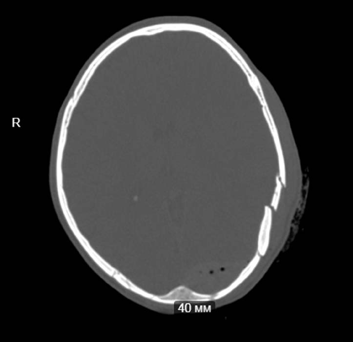 На снимке по МСКТ головного мозга в аксиальной проекции определяется депрессионный вдавленный многооскольчатый перелом теменной кости