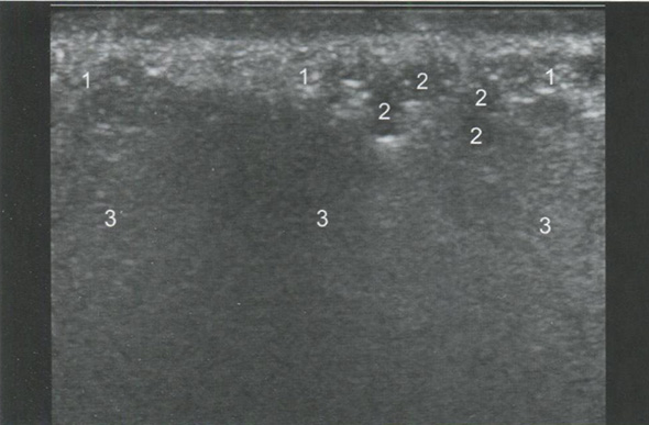 УЗ-признаки фиброзных изменений мягких тканей левой носогубной складки после КИП филлером на основе силикона