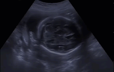 Миоматозный узел в дне матки (Беременность 22 недели)