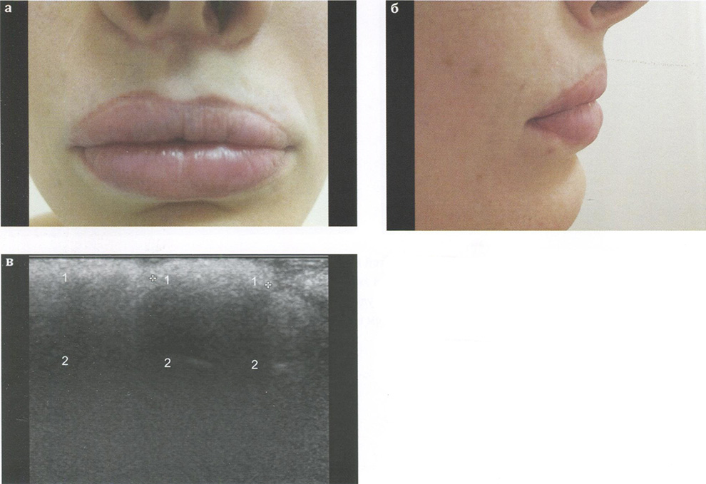 УЗ-признаки фиброзных изменений мягких тканей губ после многократных операций по поводу удаления филлера