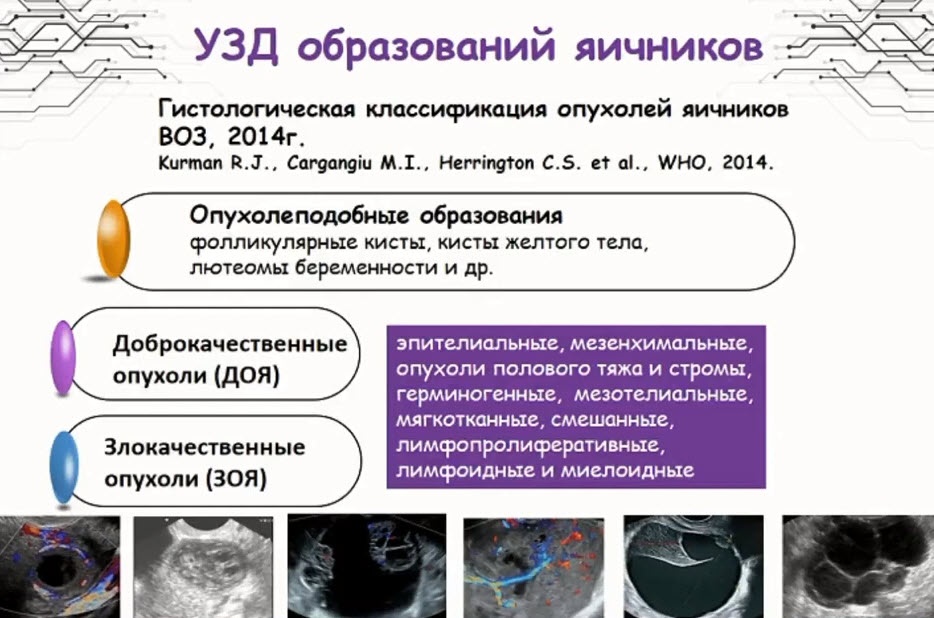 УЗД образований яичников. Гистологическая классификация опухолей яичников