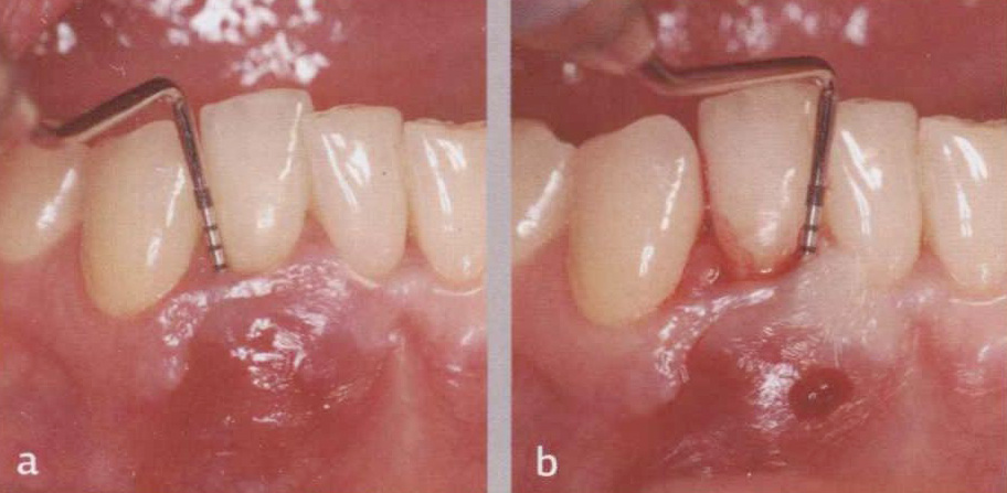 Фото 1.6. Пародонтальное зондирование с мезиальной и дистальной стороны зуба