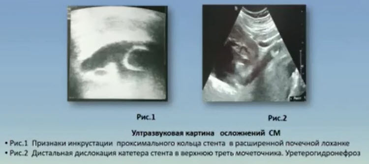 Осложнения стентирования мочеточника у беременных. Образование инкрустаций. Дислокация стента