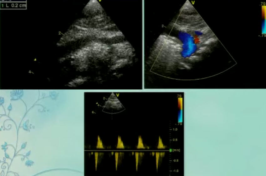 Спектр врожденных пороков сердца у новорожденных с ВДГ. Обструктивные заболевания аорты