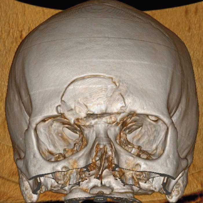 На снимке по МСКТ костей черепа в 3D-реконструкции определяется депрессионный вдавленный многооскольчатый перелом лобной пазухи.