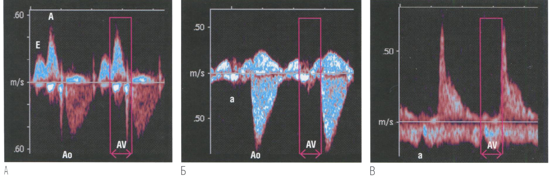 Спектрограмма кровотока через митральный клапан и выводной тракт левого желудочка