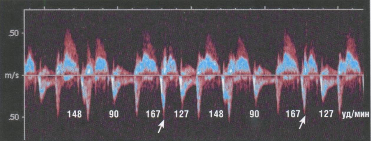Спектрограмма трансмитрального кровотока (ниже изолинии)