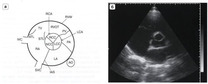 PSAX (Parasternal short axis view - парастернальная позиция, короткая ось на уровне аортального клапана)