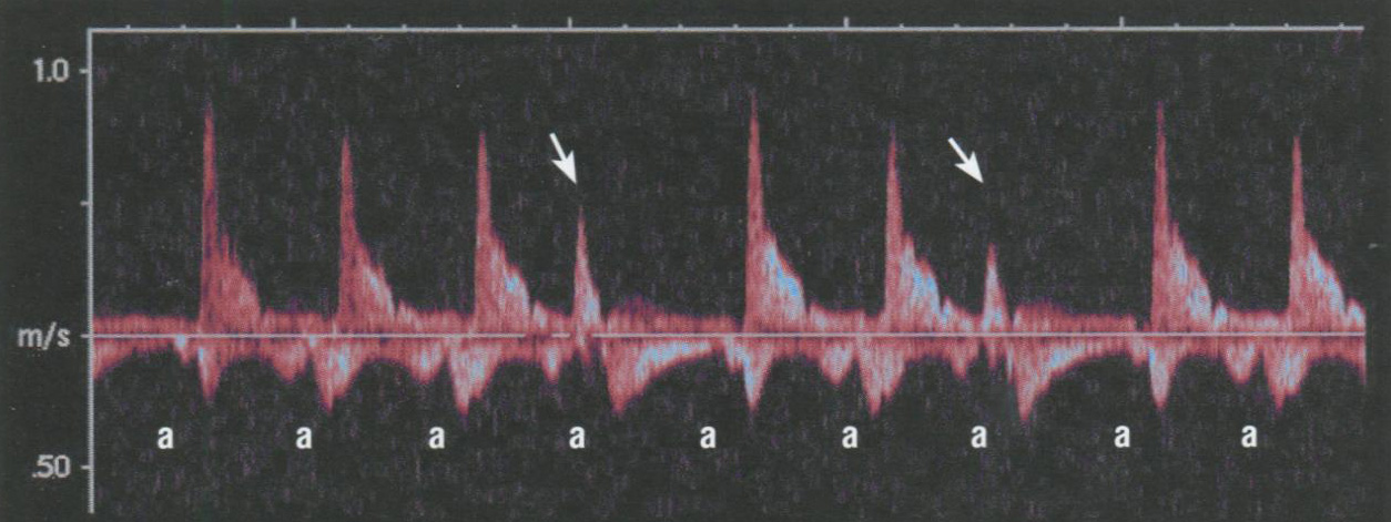  Желудочковые экстрасистолы на спектрограмме кровотока в ветви легочного ствола