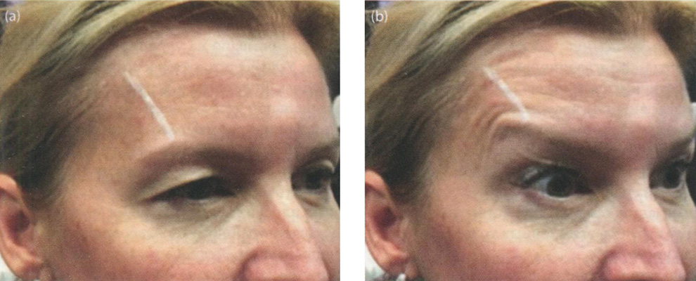 Пациентка в покое после традиционной хемоденервации лобной мышцы с помощью введения ботулотоксина медиальнее височного шва 
