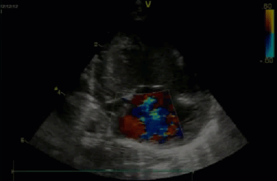 Спектр врожденных пороков сердца у новорожденных с ВДГ