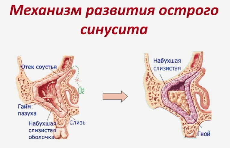 Механизм развития острого синусита