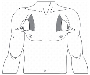 Поиск пневмоторакса проводится на передней поверхности грудной стенки