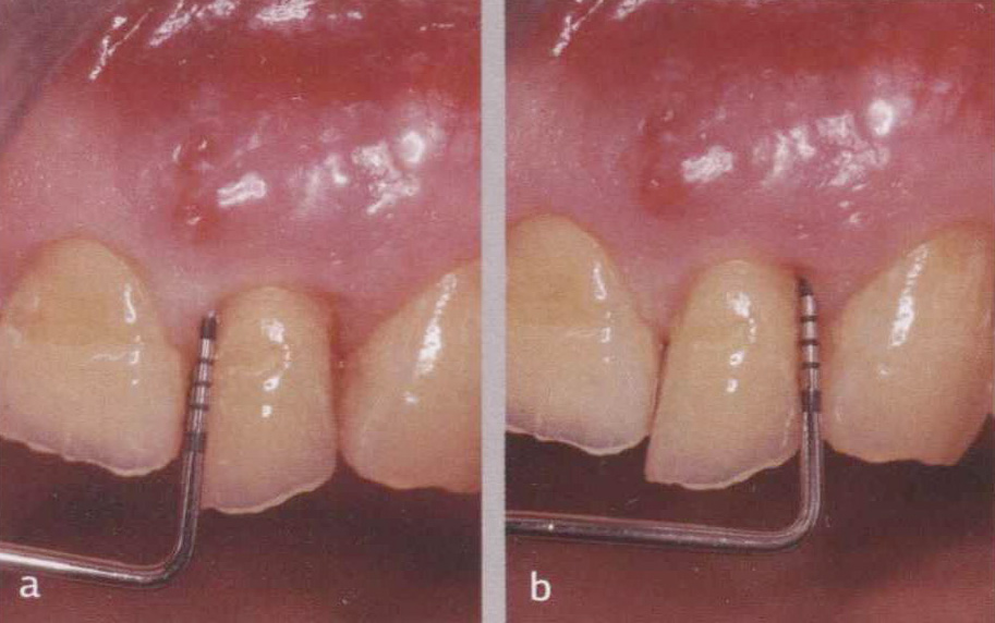 Фото 1.8. Пародонтальное зондирование с мезио- и дистовестибулярной поверхностей зуба
