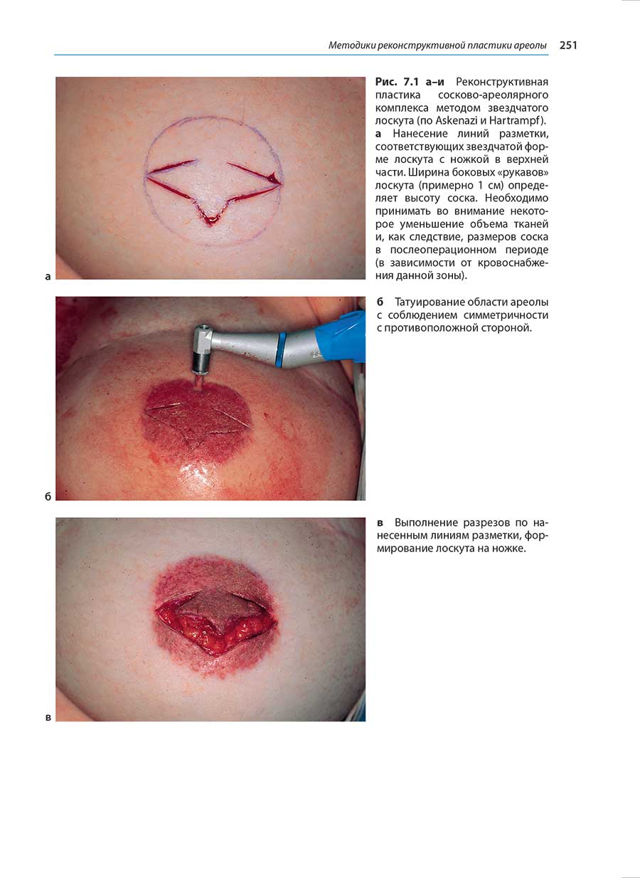 Рис. 7.1 a-и Реконструктивная пластика сосково-ареолярного комплекса методом звездчатого лоскута (по Askenazi и Hartrampf).