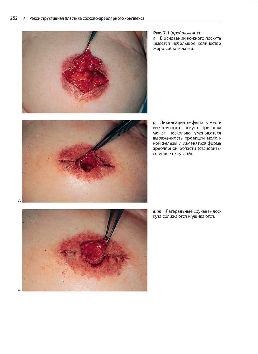 Реконструктивная пластика сосково-ареолярного комплекса